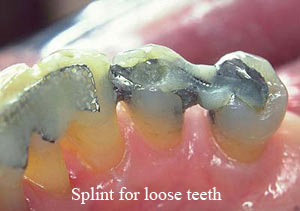 dentistry in goa splint for loose teeth