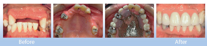 dentist in goa, cast partial dentures in goa