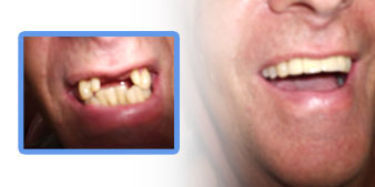 crown and bridge world class dentistry in goa