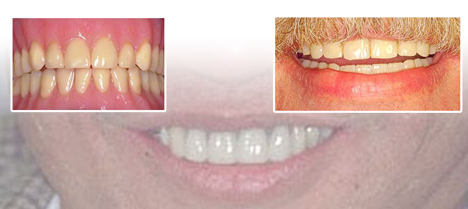 dentures in goa, dr anil dasilva world class dental clinic in goa