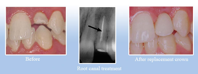 dental clinic in goa root canal treatment