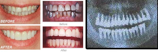 full mouth rehabilatation in goa dentist