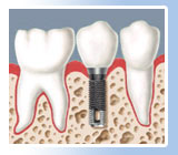 dental implant in goa