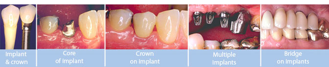 implant core crown multiple & bridge implants in goa