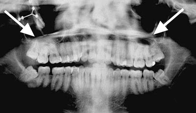 maxillary sinus lift in goa dentist