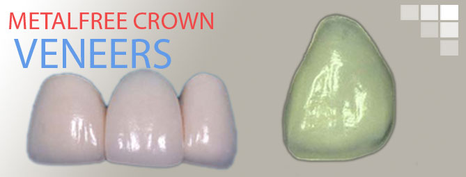 metalfree crown veneers goa, dr anil dasilva dental clinic 