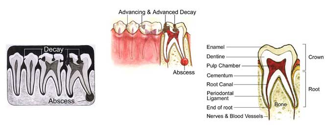 goa dentist, root canal treatment in goa, teeth decay