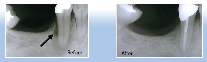 root canal treatment in goa