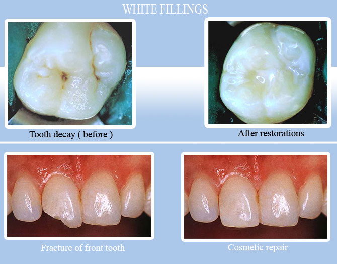 tooth filling colour restoration by dentist from goa, dr anil dasilva